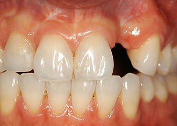 фото отсутствующего бокового резца