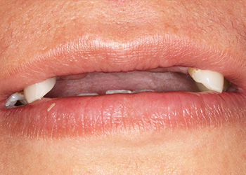 фотография до имплантации 4 зубов