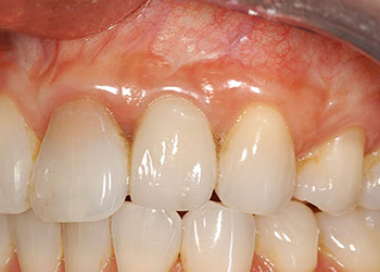 фотография после имплантации во фронтальном отделе