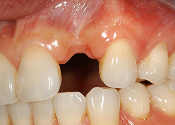 фото промежутка между 21 и 23 зубами